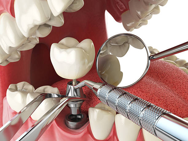 Best Broken or Cracked Tooth Emergency Dentist in Lake Holiday, IN