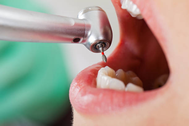 Best Emergency Dentist for Knocked-Out Tooth in Lake Holiday, IN